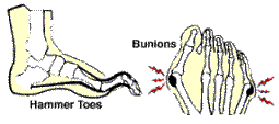 hammer toes / bunion from badly fitting dance shoes